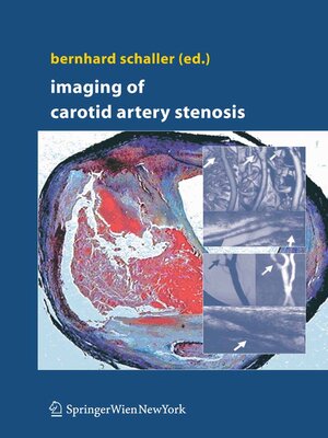 cover image of Imaging of Carotid Artery Stenosis